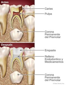 Endodoncia infantil