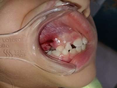 Granuloma piogeno cirugía.